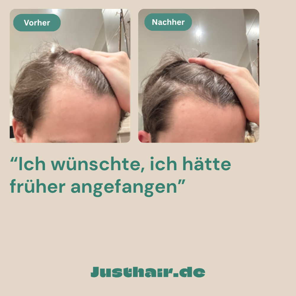 Meine Erfahrung mit oralem Minoxidil 👨🏻